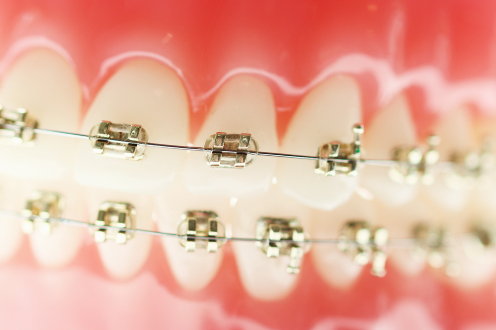 Fixed metal braces treatment
