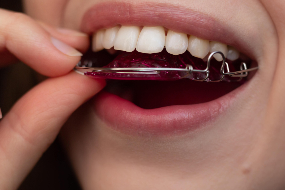 Retainers